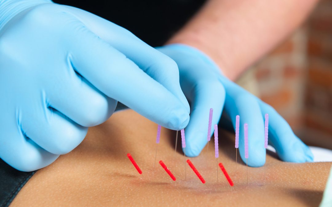 IMS / Dry Needling Penticton Physiotherapy